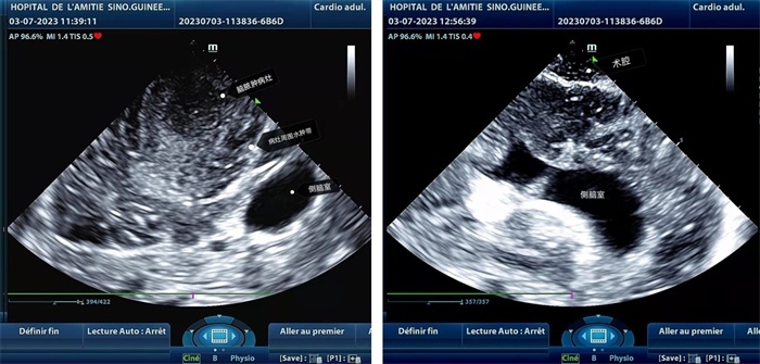左圖顯示術(shù)中超聲見囊實(shí)性病變，大小約為4x4x3cm，病灶周圍腦組織水腫明顯；右圖為病灶切除后，術(shù)中超聲示術(shù)腔無病變殘留