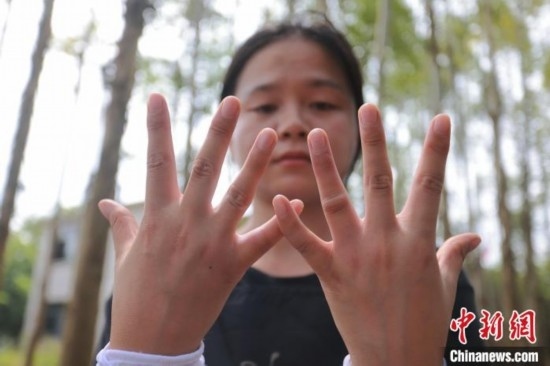 吳素英展示被蜜蜂蜇過的雙手。湯曉逵 攝