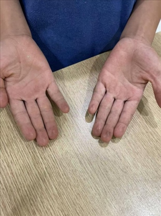 9歲小學(xué)生長(zhǎng)期拍煙卡，手部粗糙長(zhǎng)繭。受訪者供圖