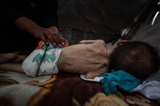 這是5月28日在加沙城西部一處臨時安置點拍攝的一名營養(yǎng)不良的嬰兒。新華社發(fā)（馬哈茂德·扎基攝）
